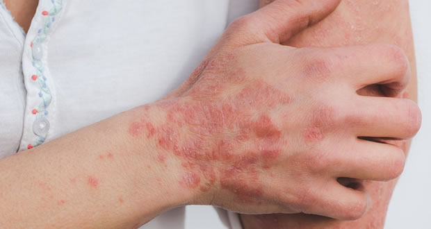 Psoriasis